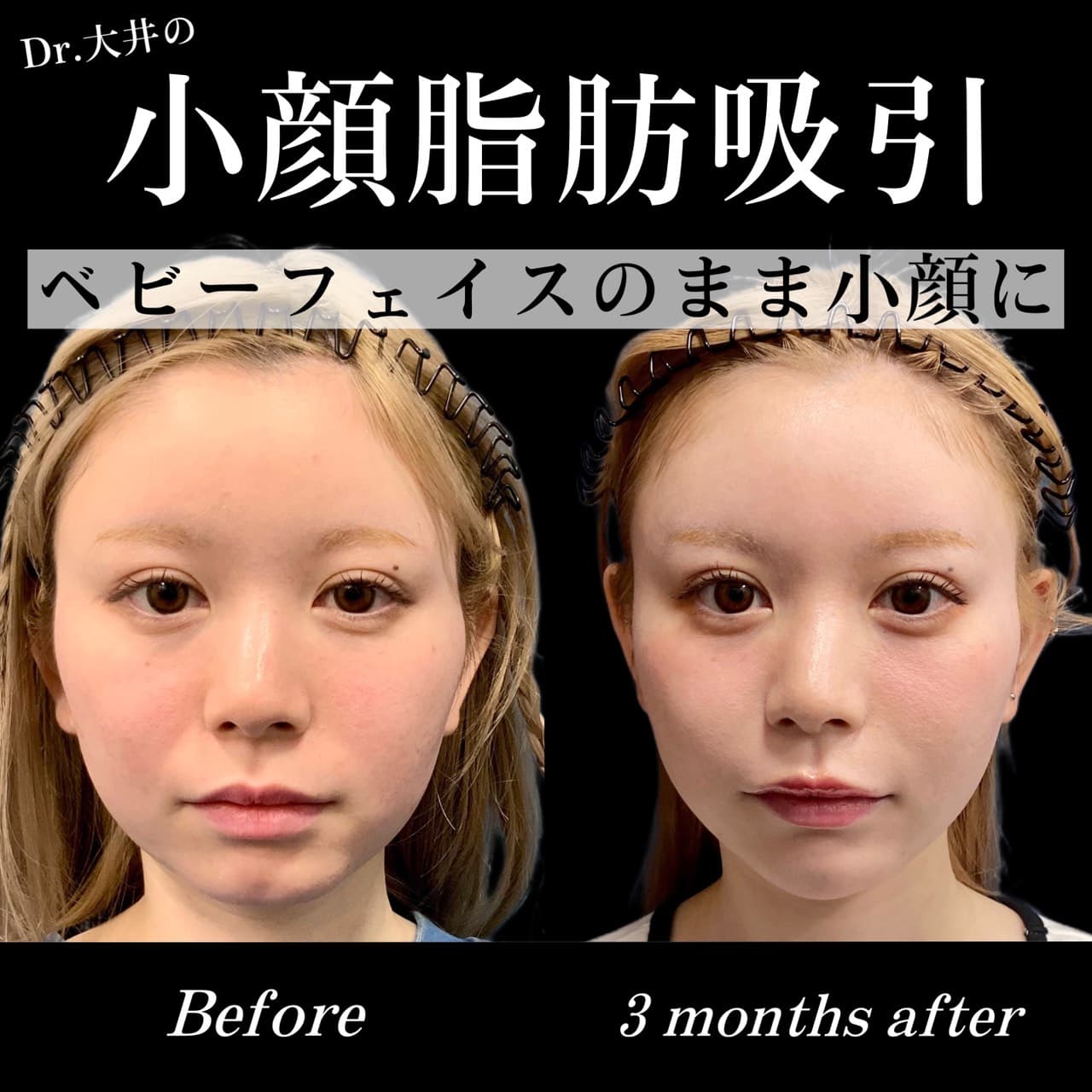 小顔脂肪吸引 Before/After