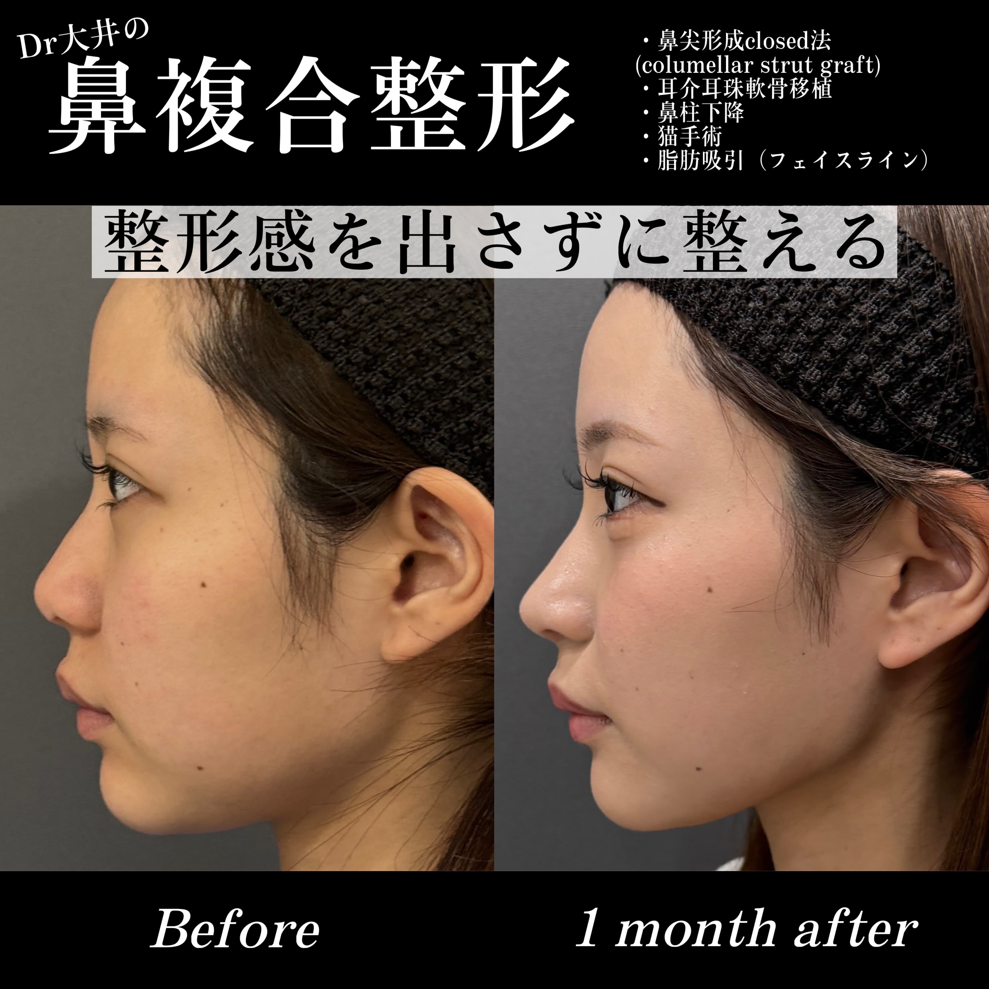 鼻複合整形 整形感を出さずに整える(鼻尖形成closed法(columellar strut graft)・耳介耳珠軟骨移植・鼻柱下降・猫手術・脂肪吸引(フェイスライン))