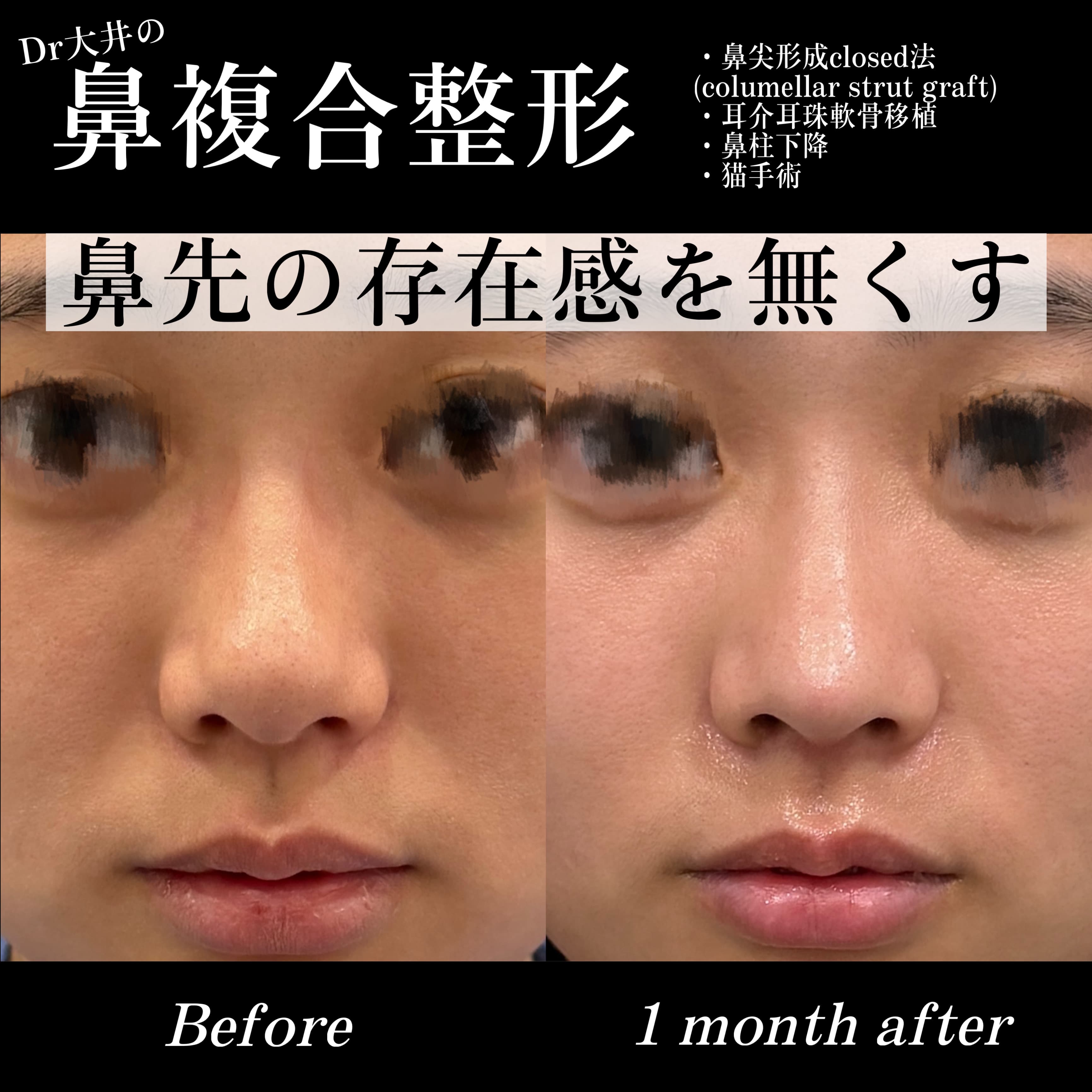 鼻複合整形 鼻先の存在感を無くす(鼻尖形成closed法(columellar strut graft)・耳介耳珠軟骨移植・鼻柱下降・猫手術)