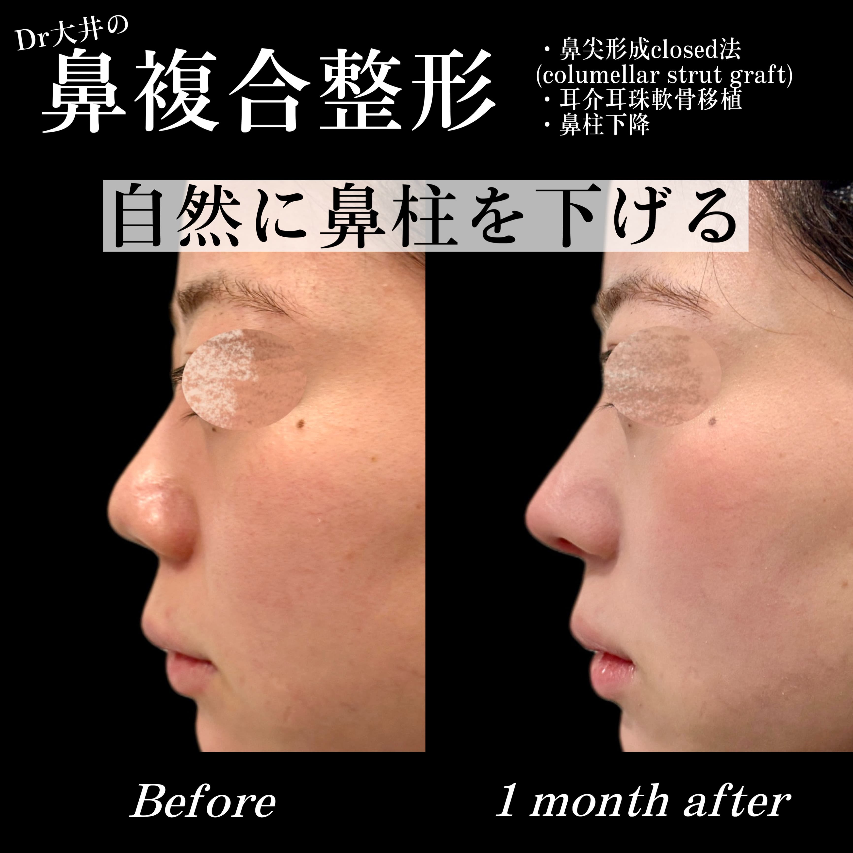 鼻複合整形 自然に鼻柱を下げる(鼻尖形成・耳介耳珠軟骨移植・鼻柱下降)